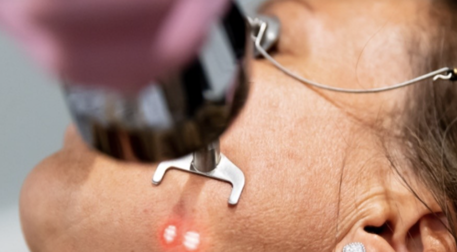 close-up of woman receiving profractional treatment